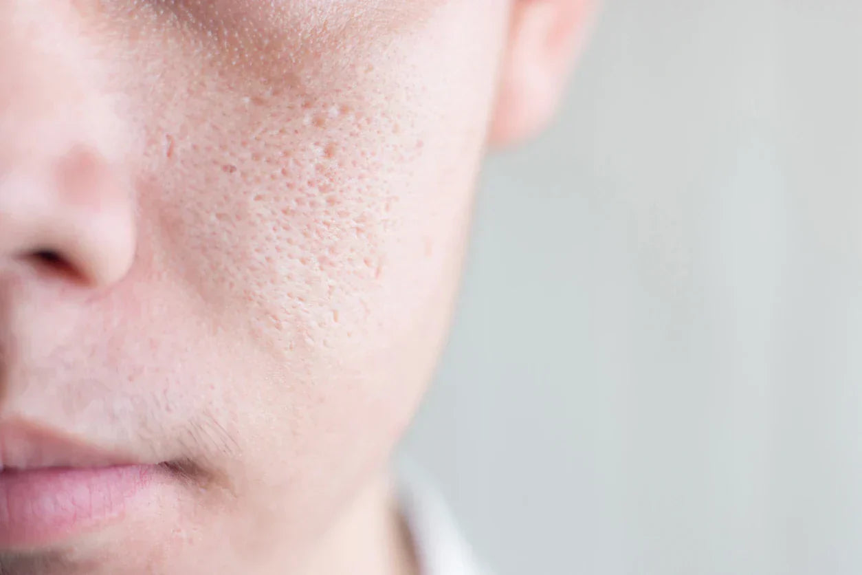 What are Pores? How to Get Rid of Pore Problems?